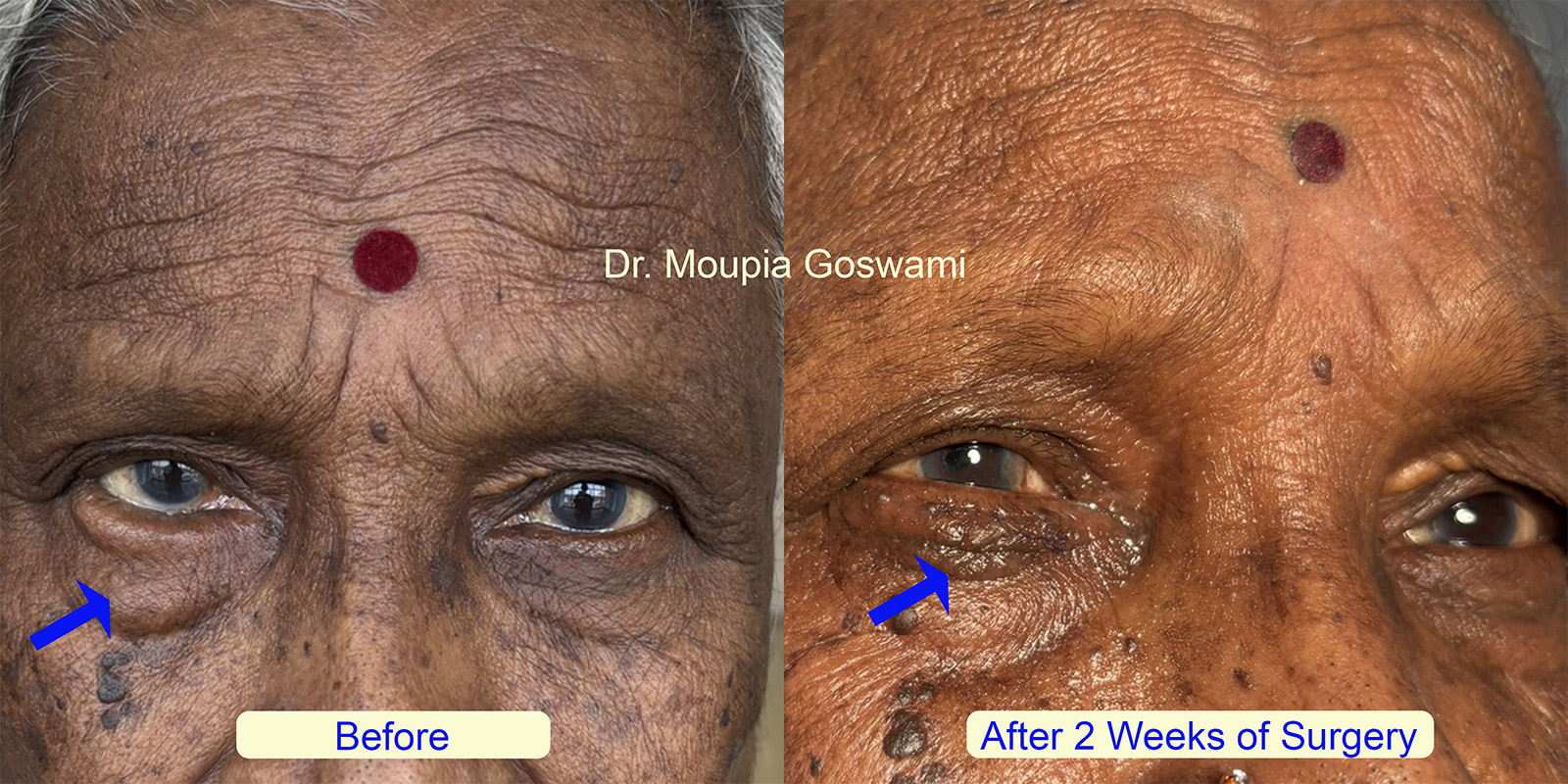 Entropion Surgery Before and After - Case 2